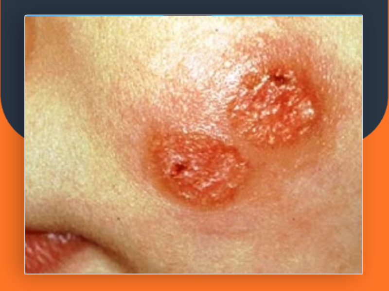 بعد تسجيل 14 إصابة.. مخاوف من تفشي مرض الليشمانيا في قرية حيفا الكرمل