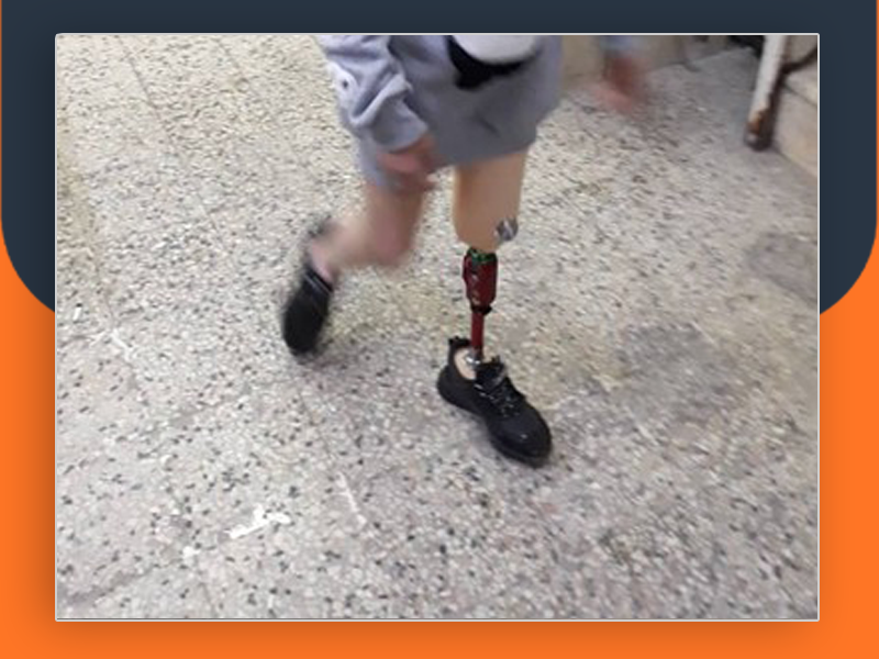 مخيم النيرب. طفلة فلسطينية تناشد للتكفل بتركيب طرف صناعي لقدمها المبتورة